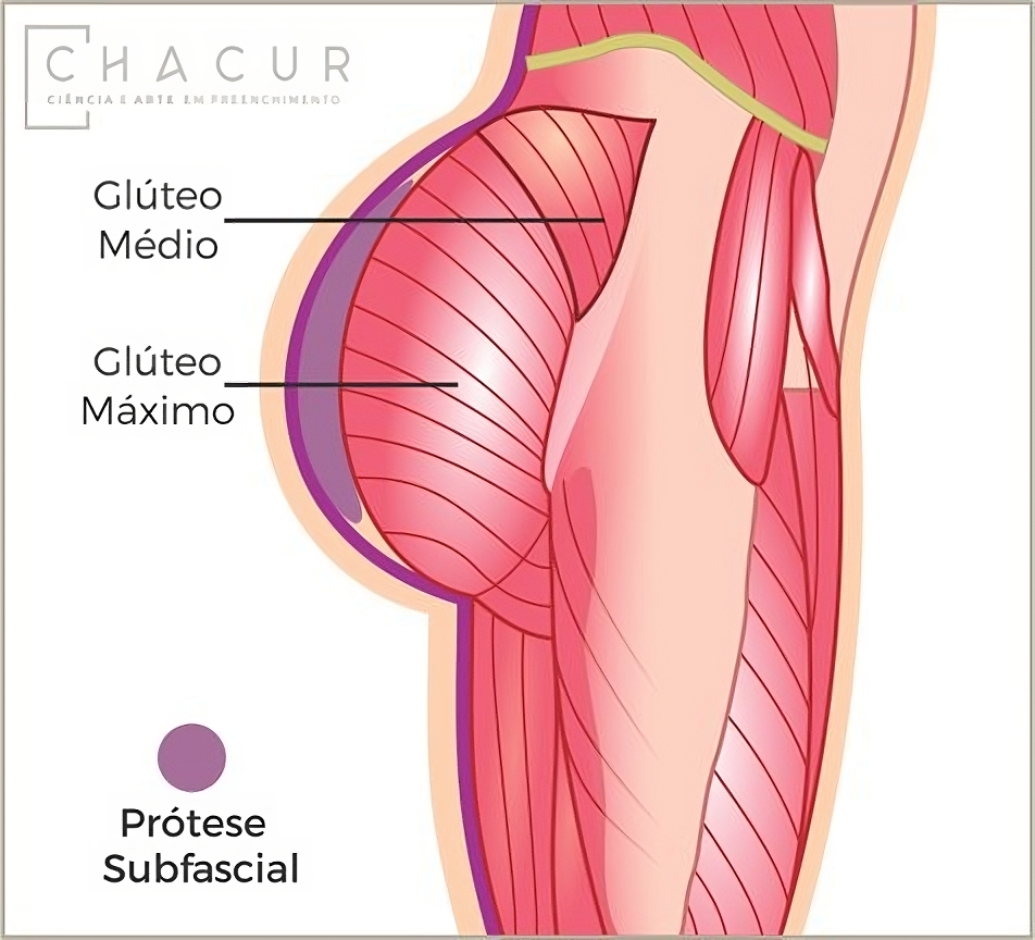 Prótese do tipo subfascial no glúteo